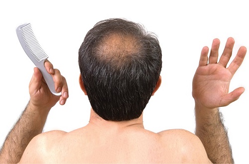 Mẹo điều trị rụng tóc ở nam giới 
