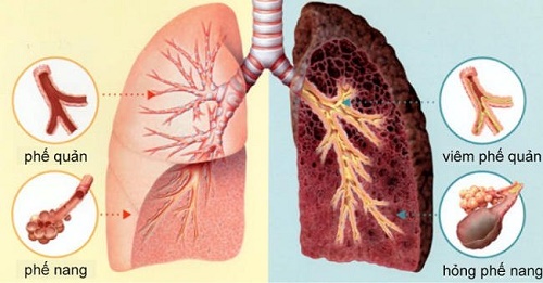 Nguyên nhân và cách phòng tránh ung thư phổi 