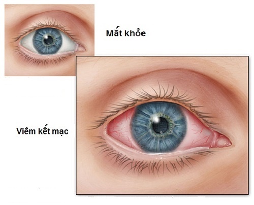 Các biến chứng về mắt của bệnh tiểu đường 