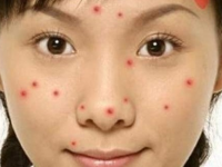 Nguyên nhân và các trị mụn trứng cá đơn giản