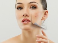 Nguyên nhân gây ra sẹo thâm và mẹo thổi bay sẹo thâm nhanh chóng